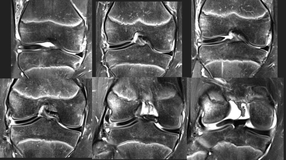 Figure 5 for case discoid lateral meniscus ( RID2771 )